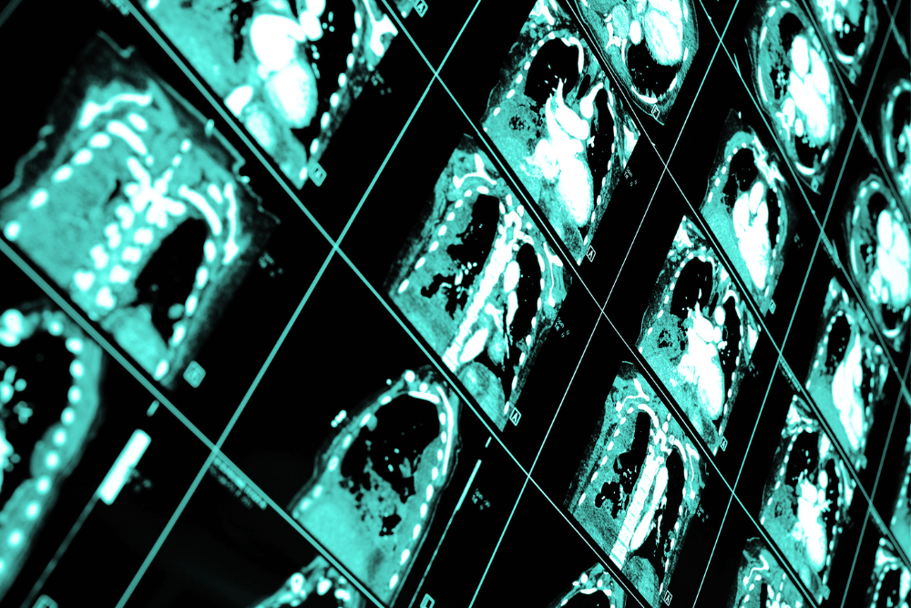 imagenes de tomografia de torax en el cma merida
